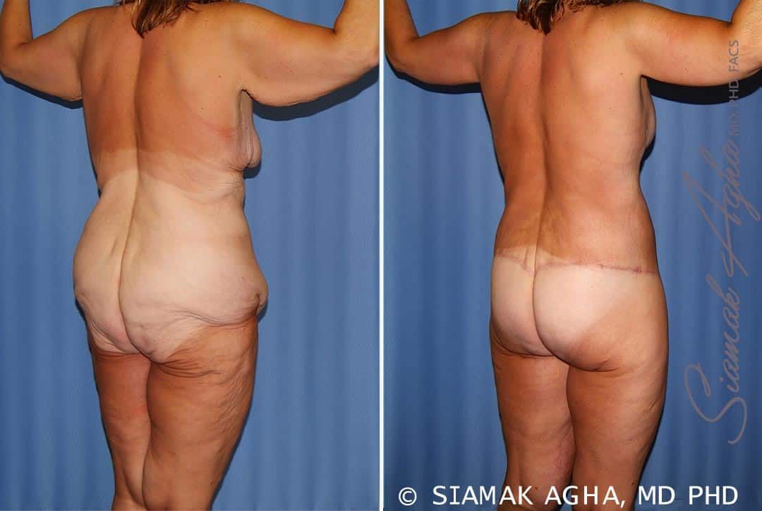 Total Body Lift Before & After