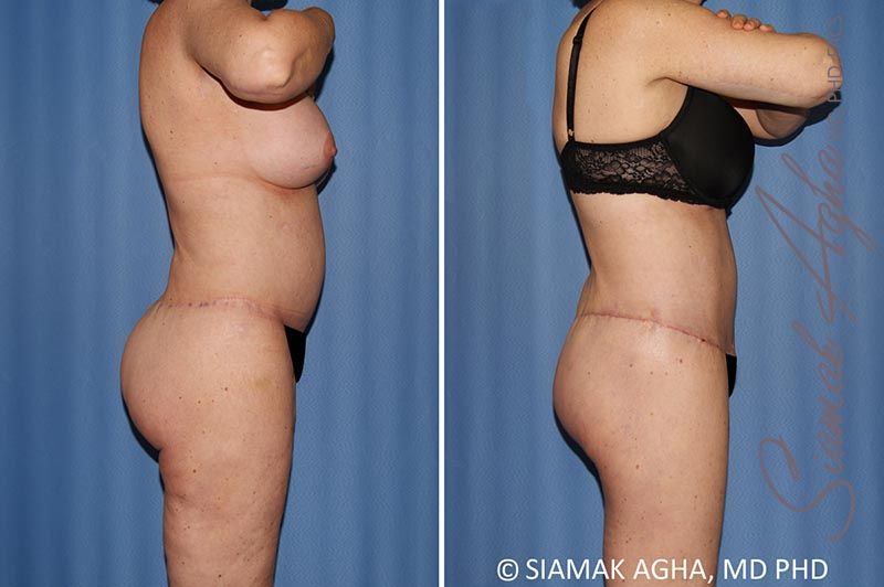 Total Body Lift Before & After