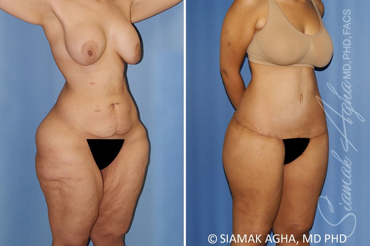 Total Body Lift Before & After