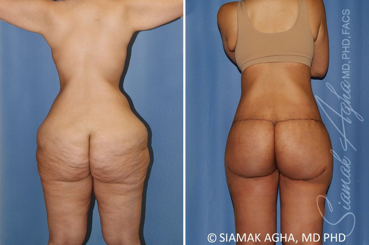 Total Body Lift Before & After