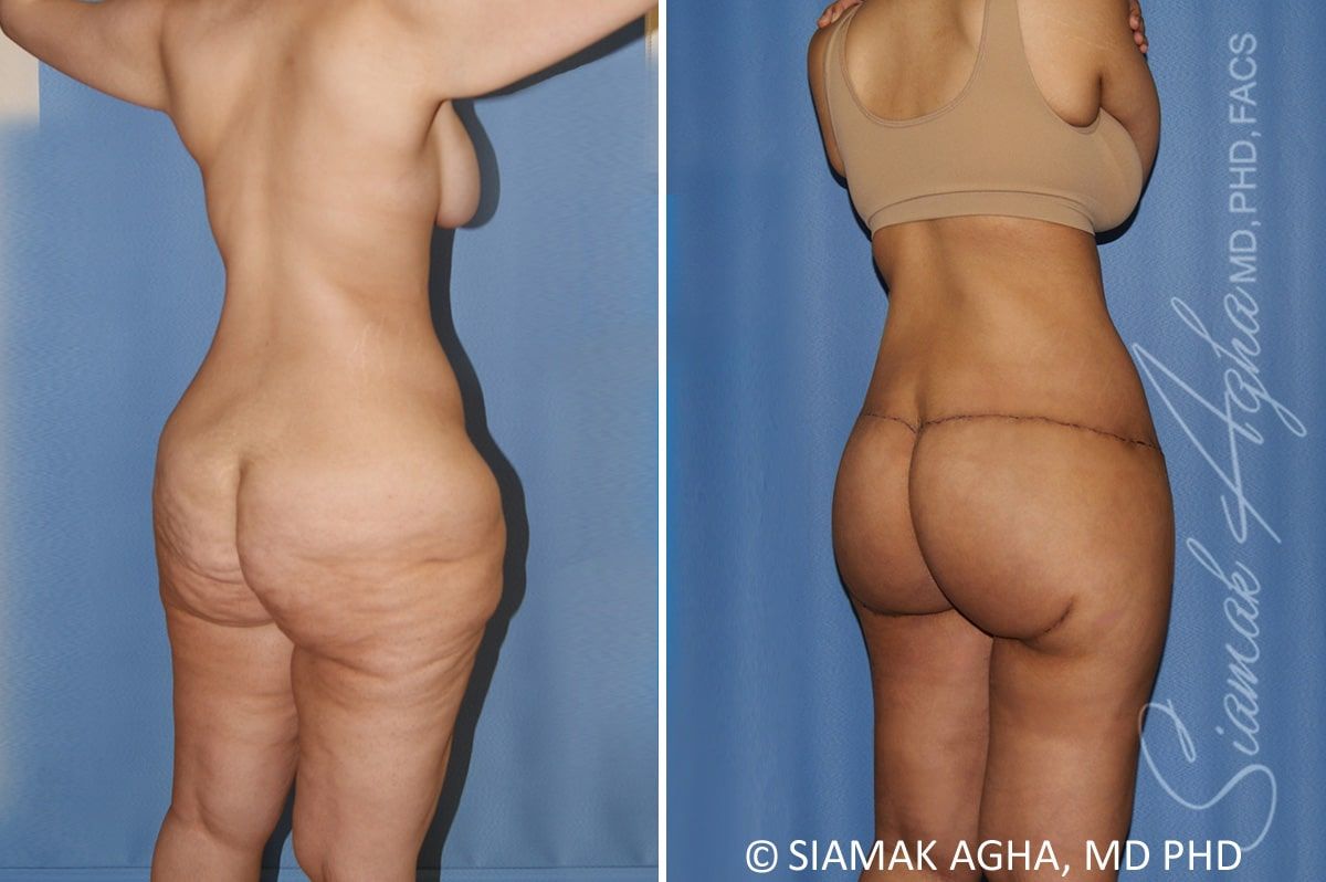 Total Body Lift Before & After