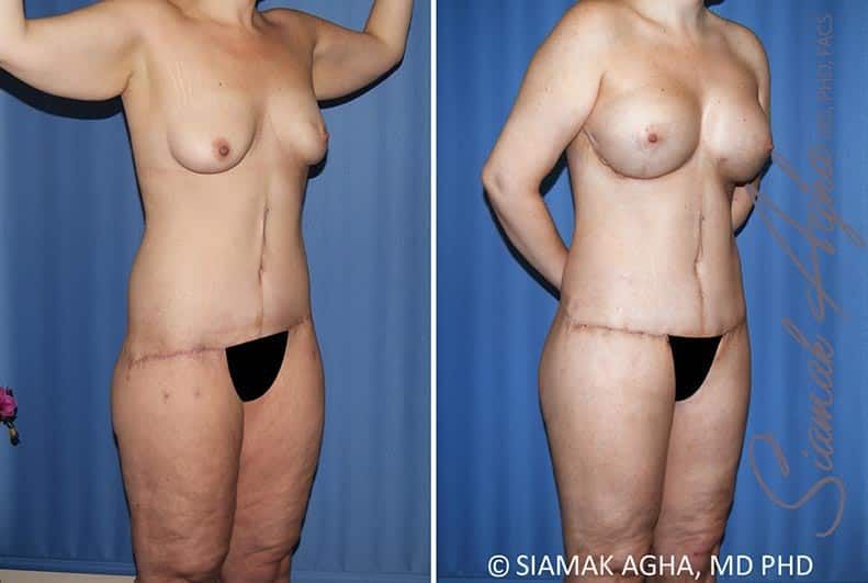 Total Body Lift Before & After