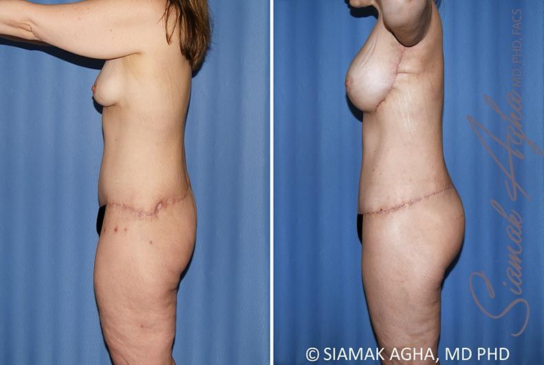 Total Body Lift Before & After