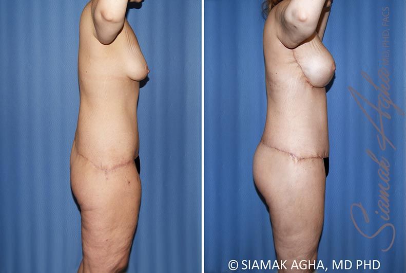 Total Body Lift Before & After