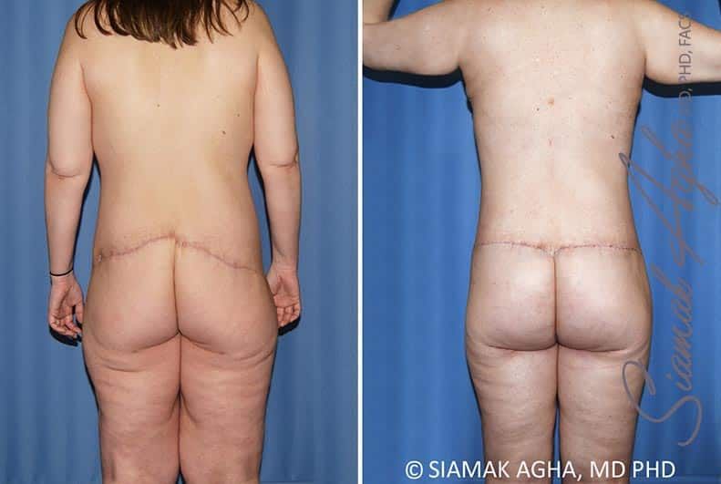 Total Body Lift Before & After