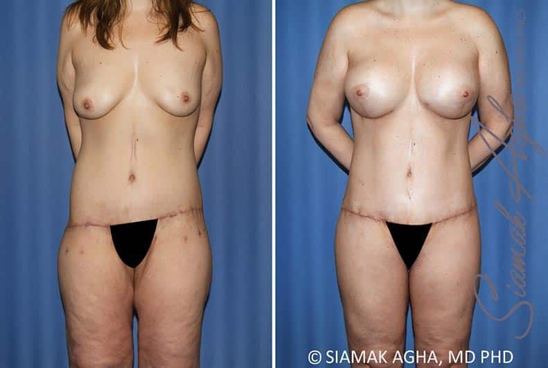 Total Body Lift Before & After