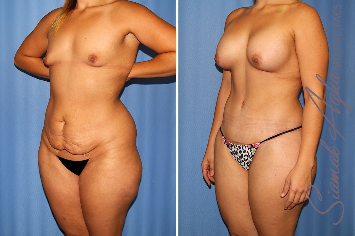 Total Body Lift Before & After