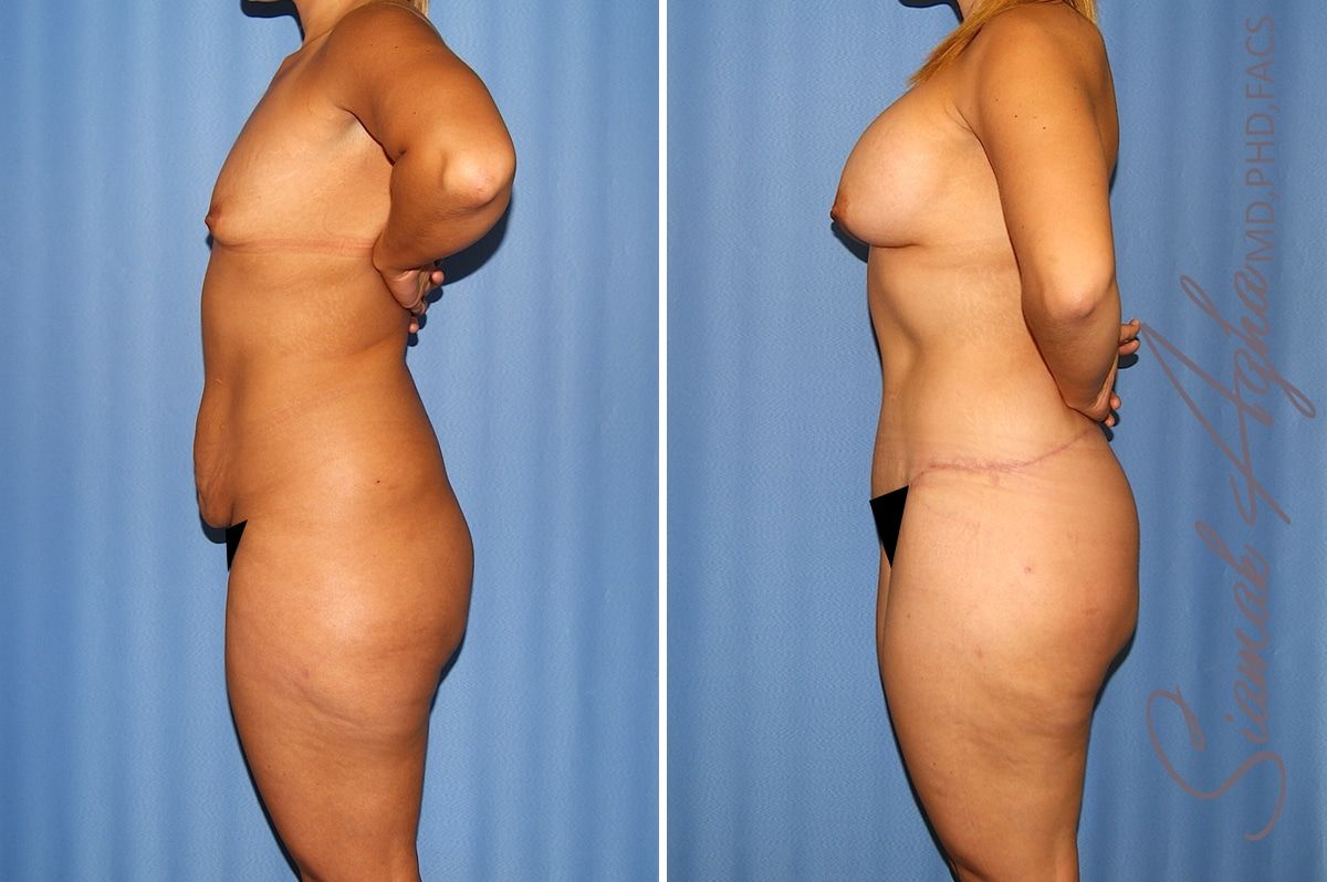 Total Body Lift Before & After