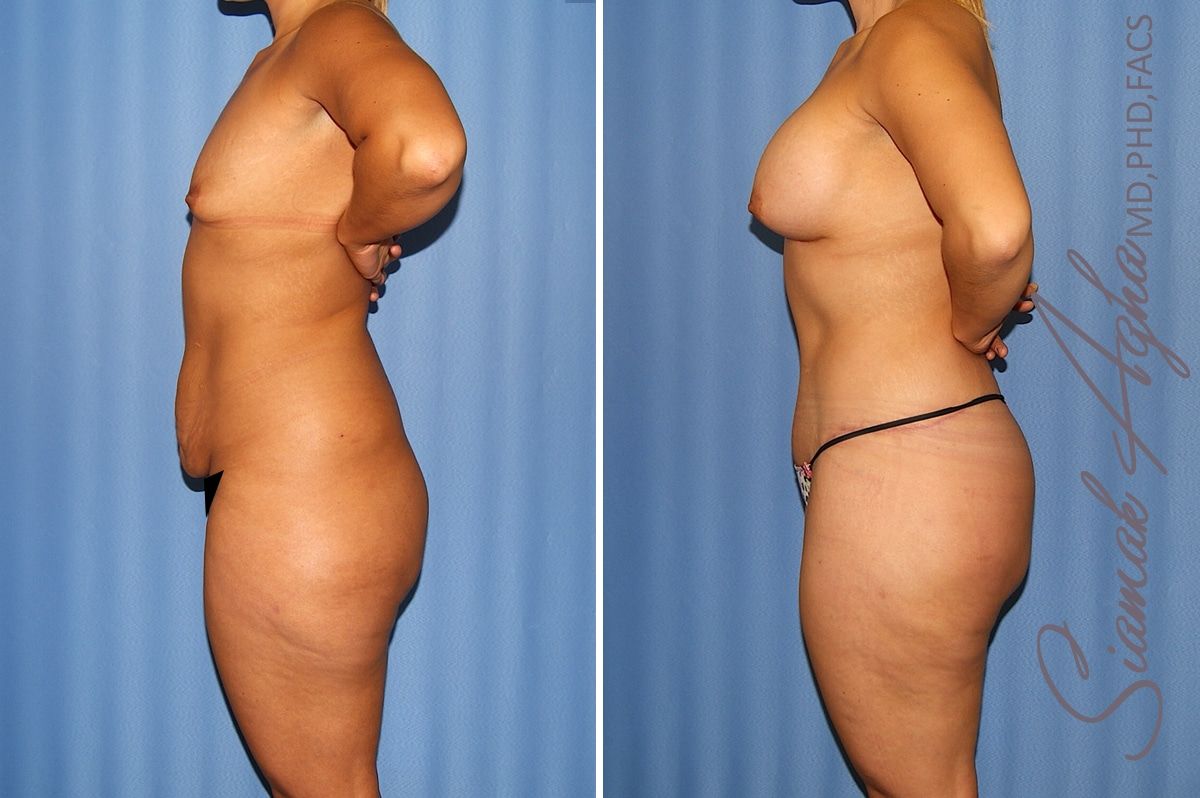 Total Body Lift Before & After