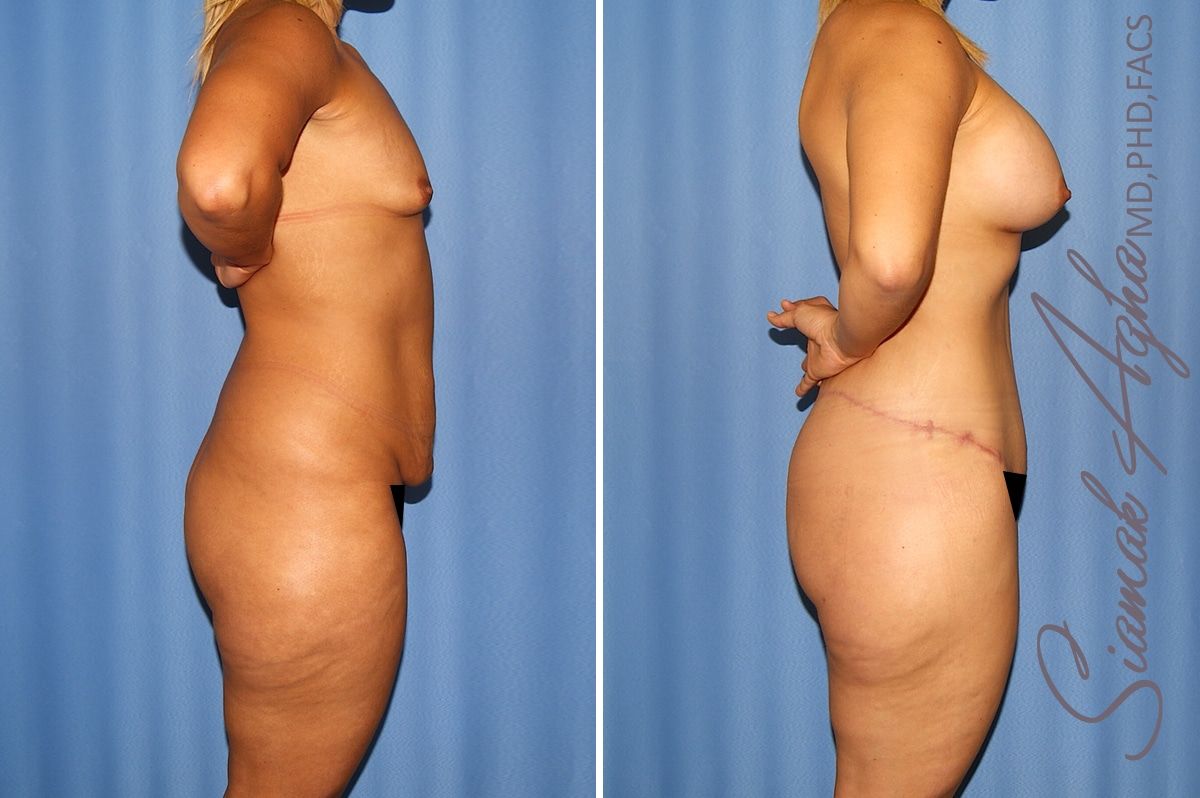 Total Body Lift Before & After
