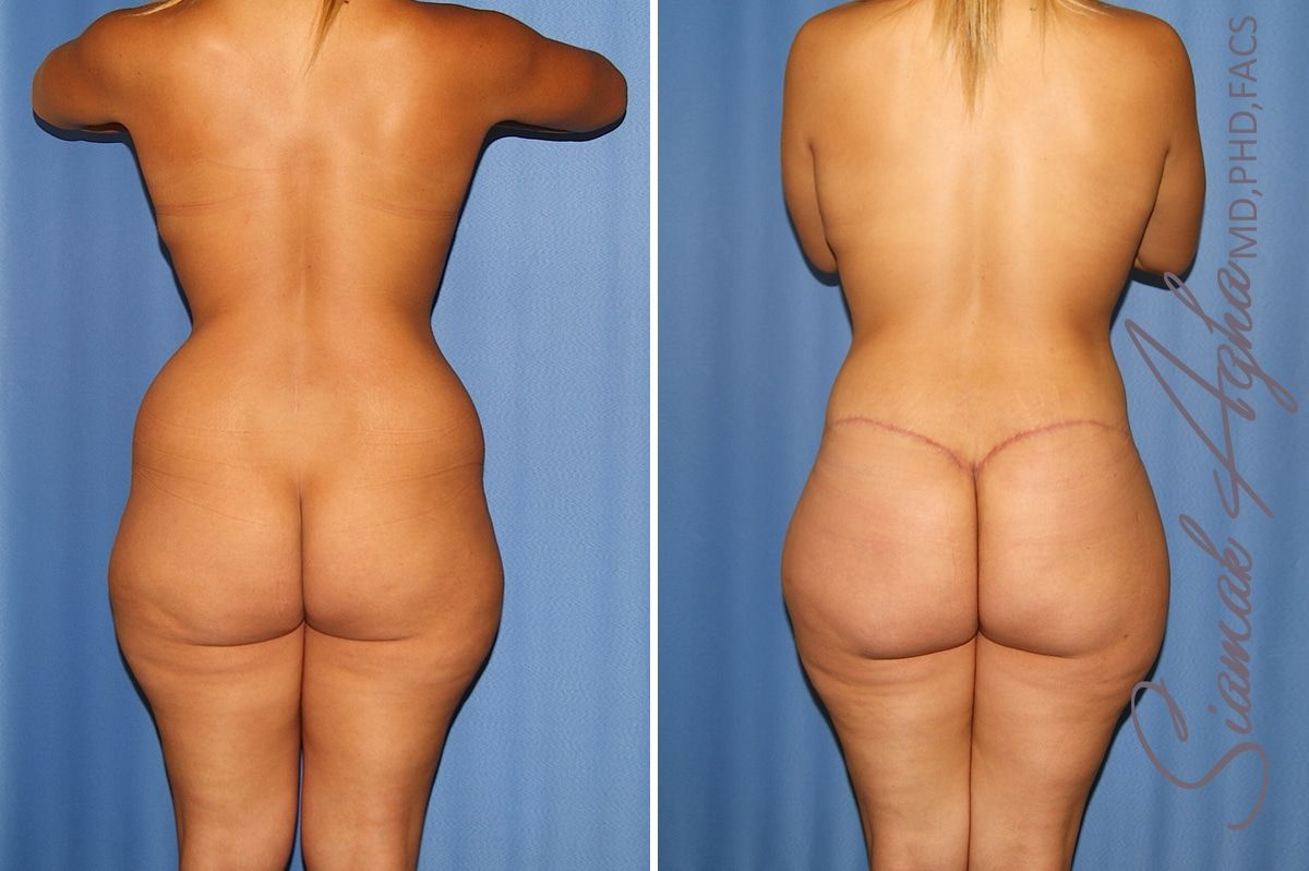 Total Body Lift Before & After