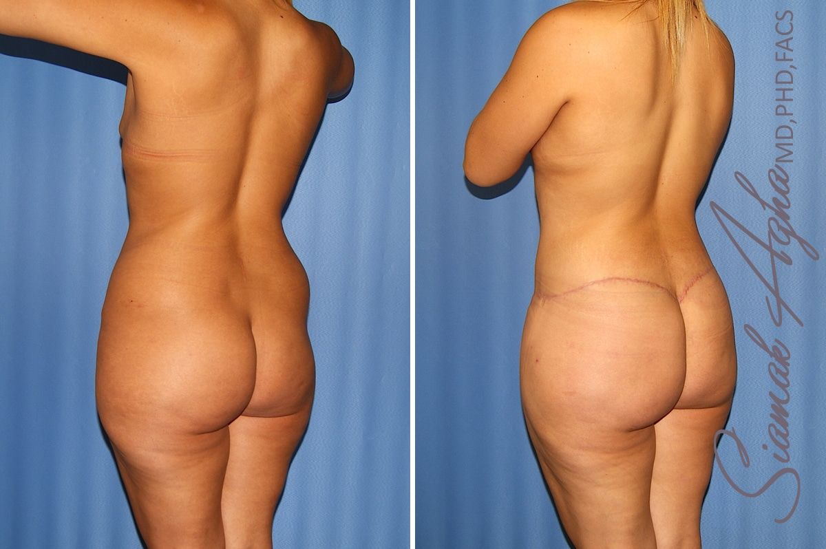 Total Body Lift Before & After