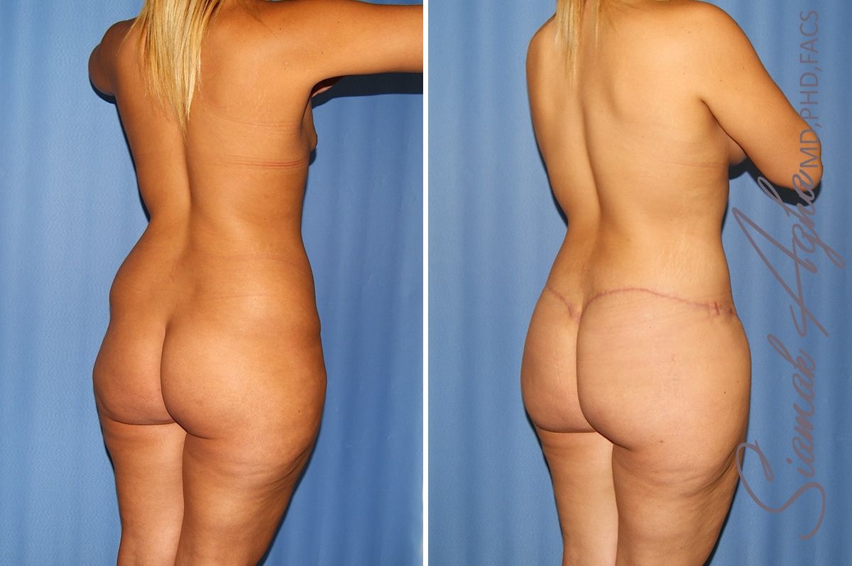 Total Body Lift Before & After