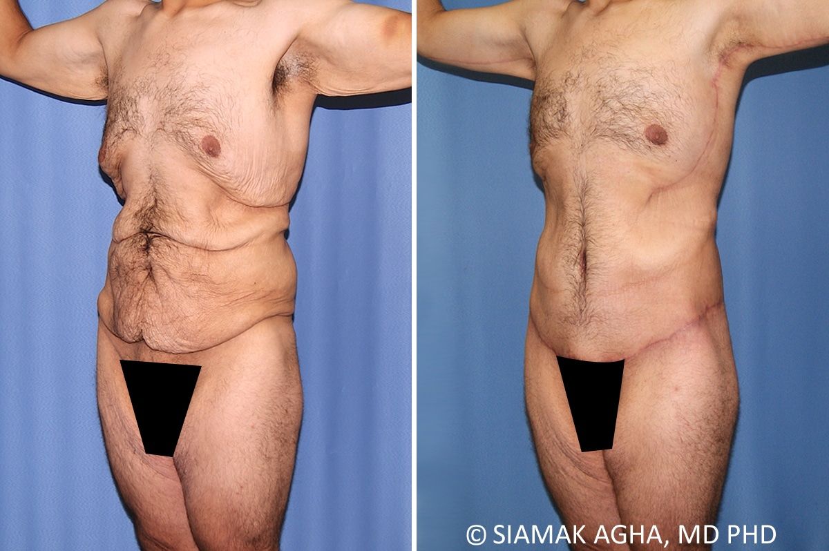 Total Body Lift Before & After