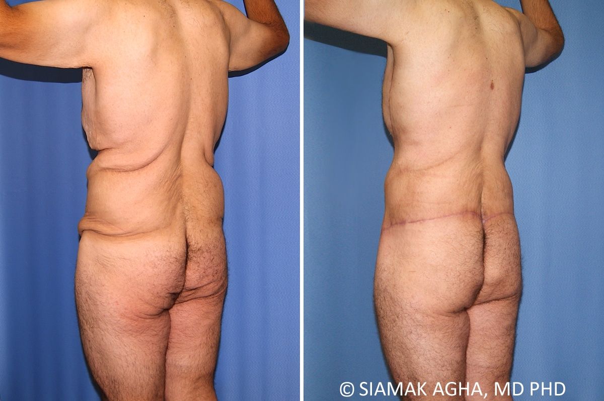 Total Body Lift Before & After