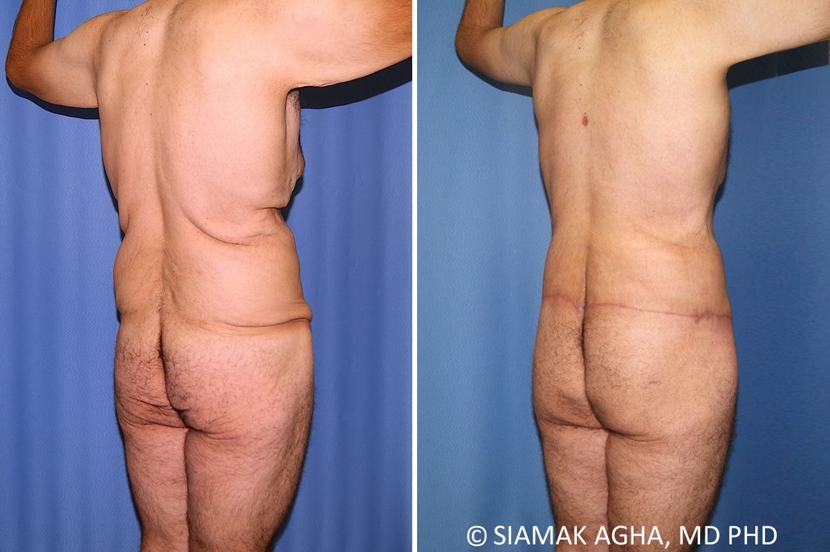 Total Body Lift Before & After