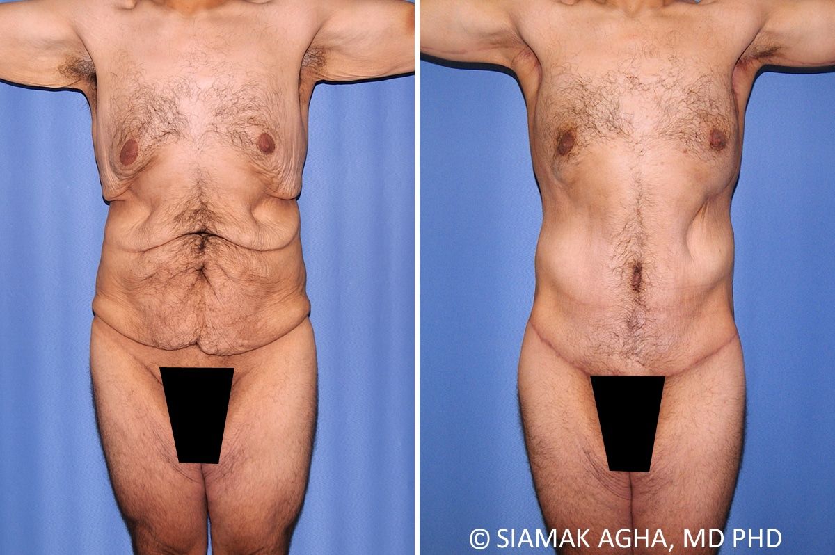 Total Body Lift Before & After