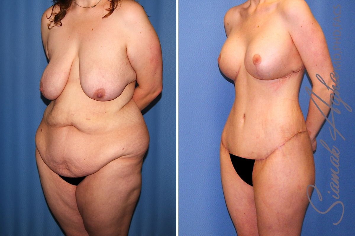 Total Body Lift Before & After