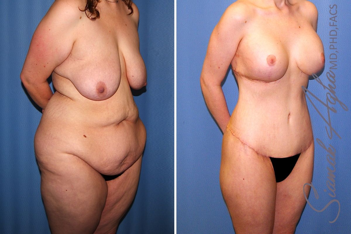 Total Body Lift Before & After