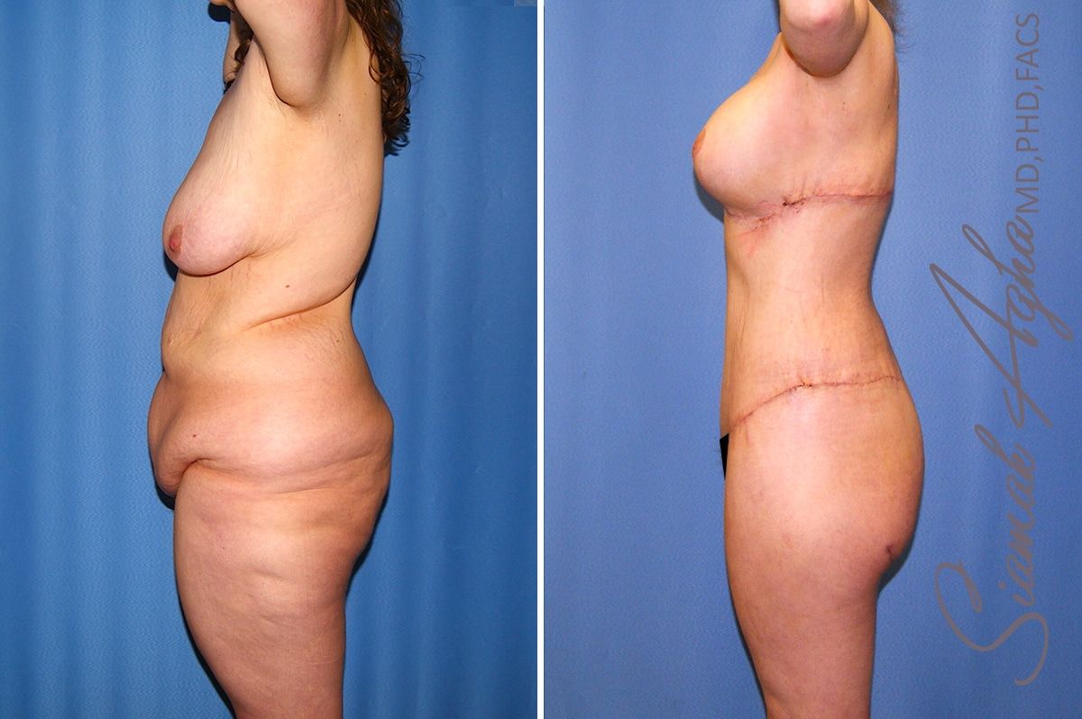 Total Body Lift Before & After