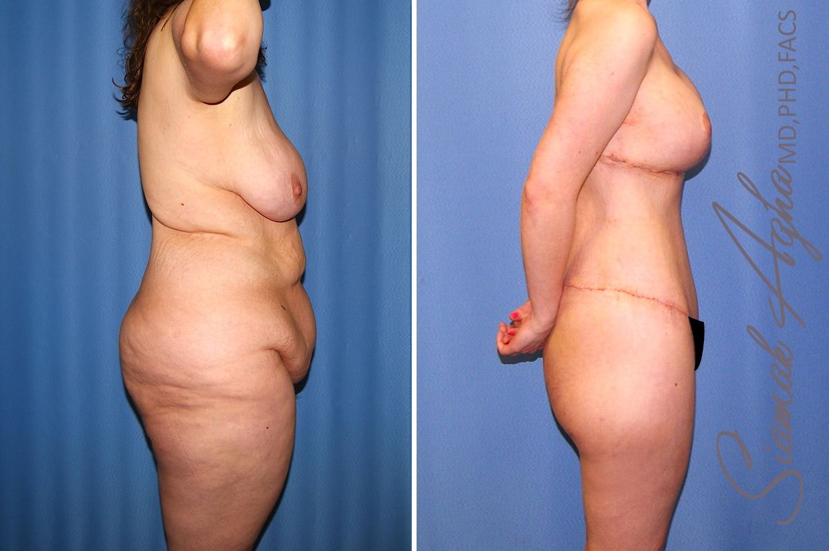 Total Body Lift Before & After