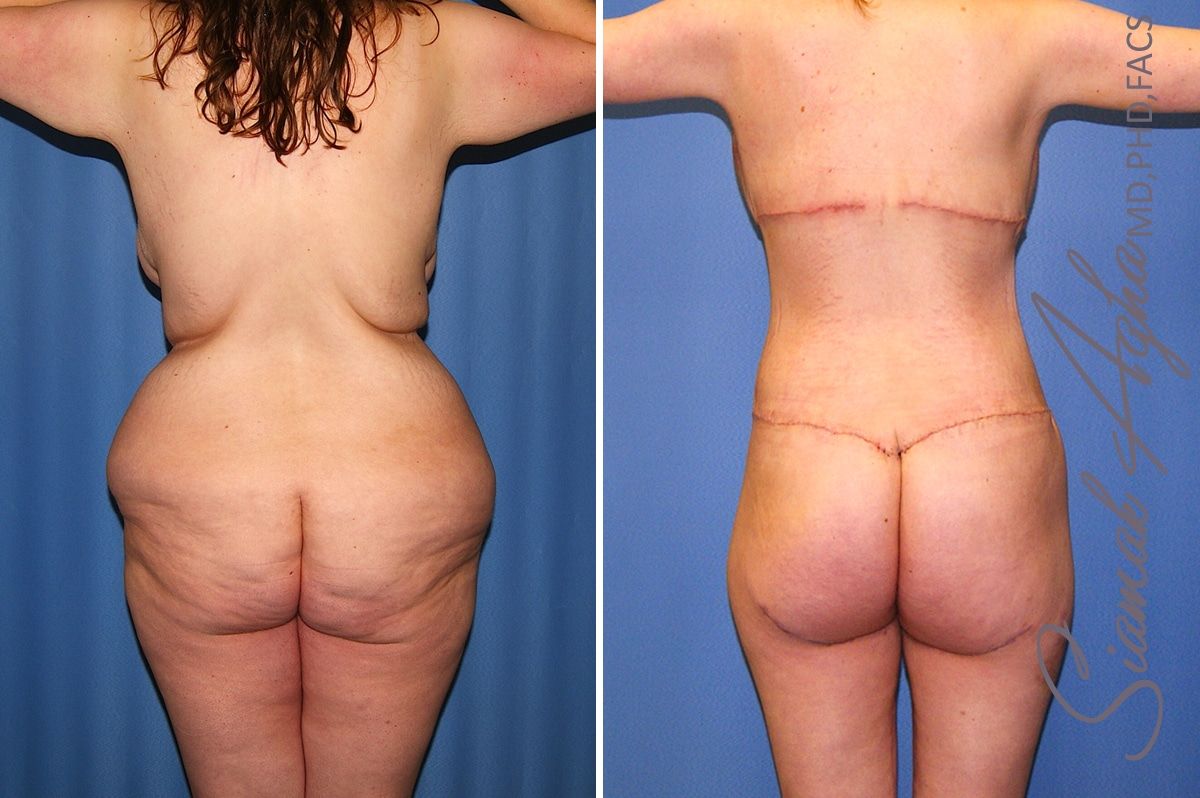 Total Body Lift Before & After