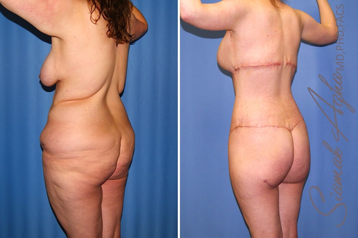 Total Body Lift Before & After