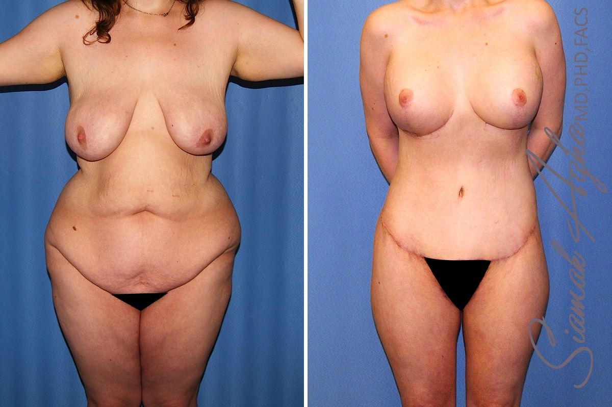 Total Body Lift Before & After