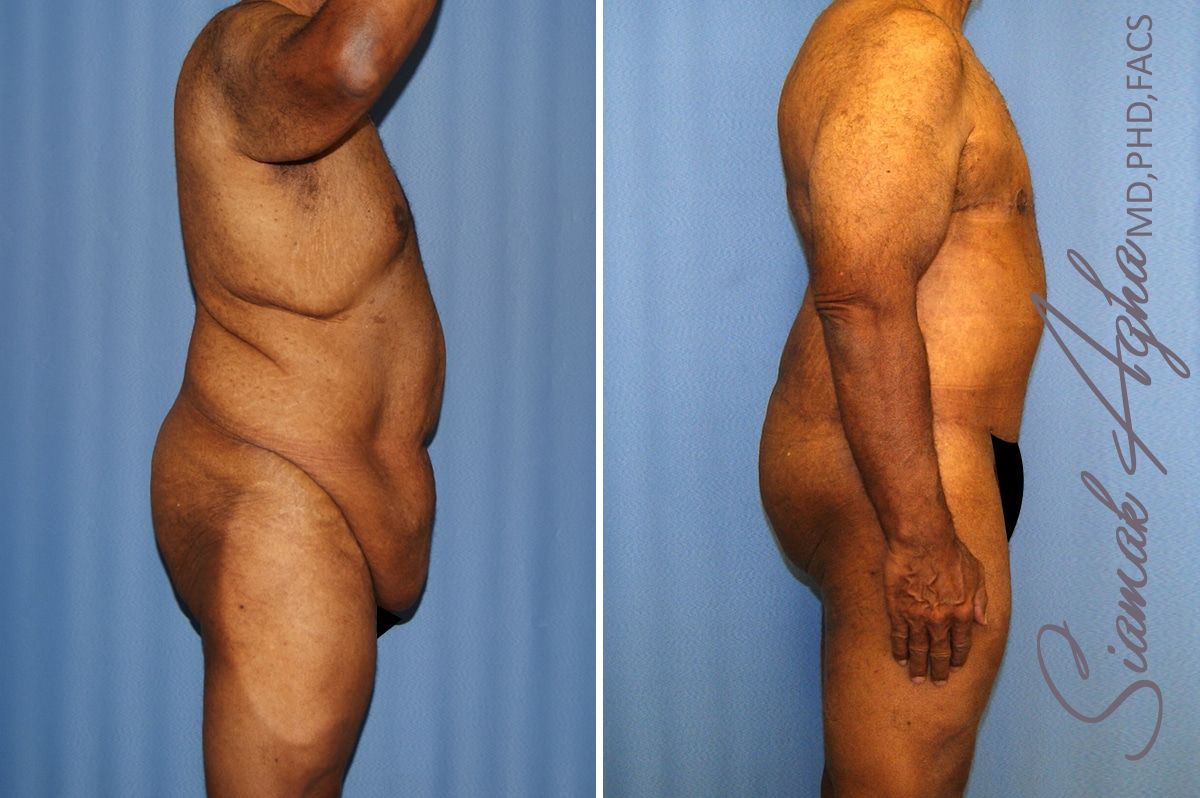 Total Body Lift Before & After