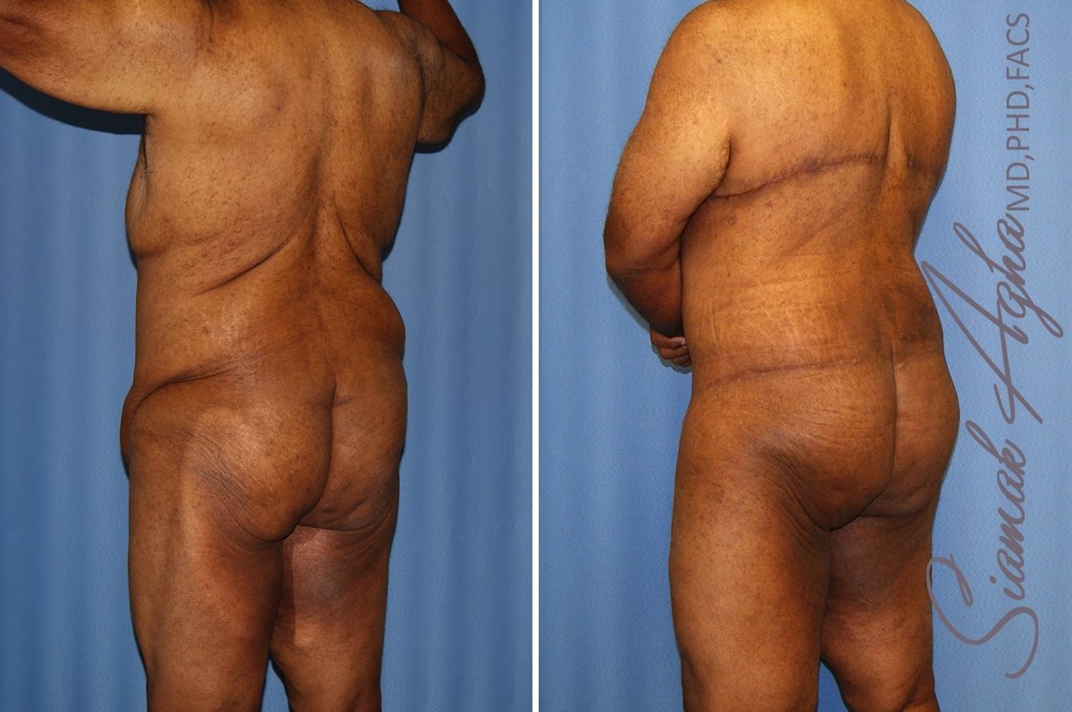 Total Body Lift Before & After