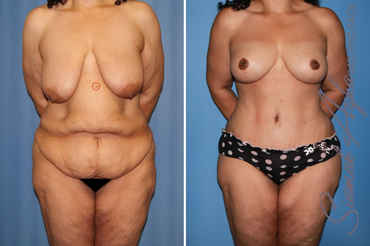 Total Body Lift Before & After