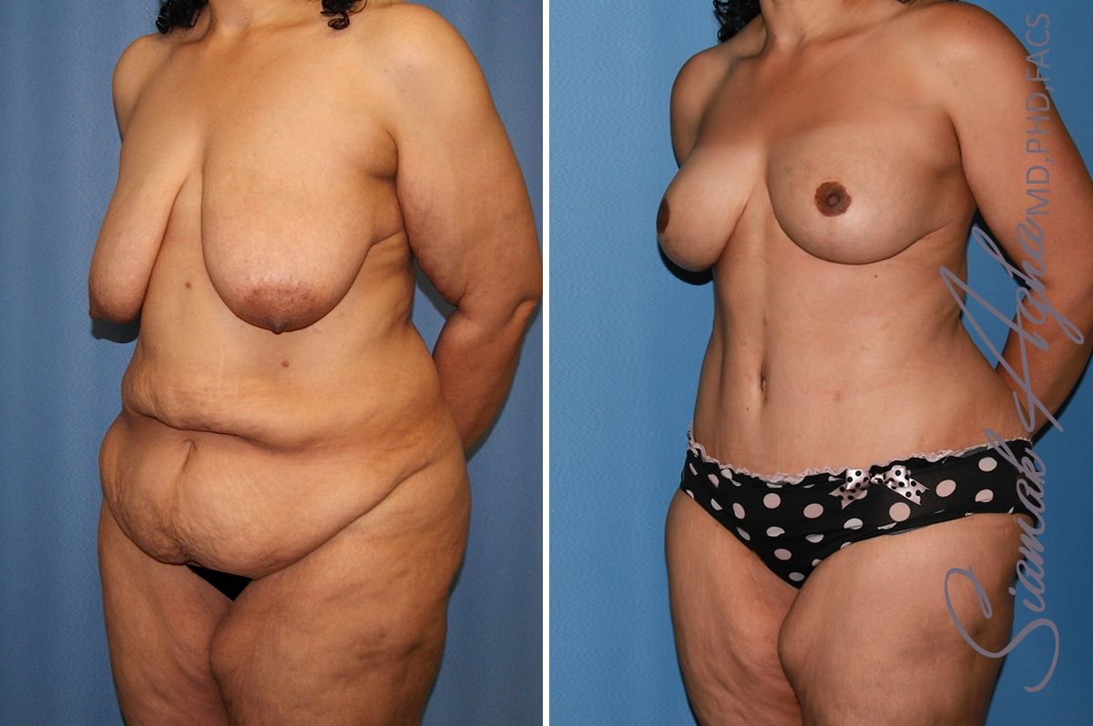 Total Body Lift Before & After
