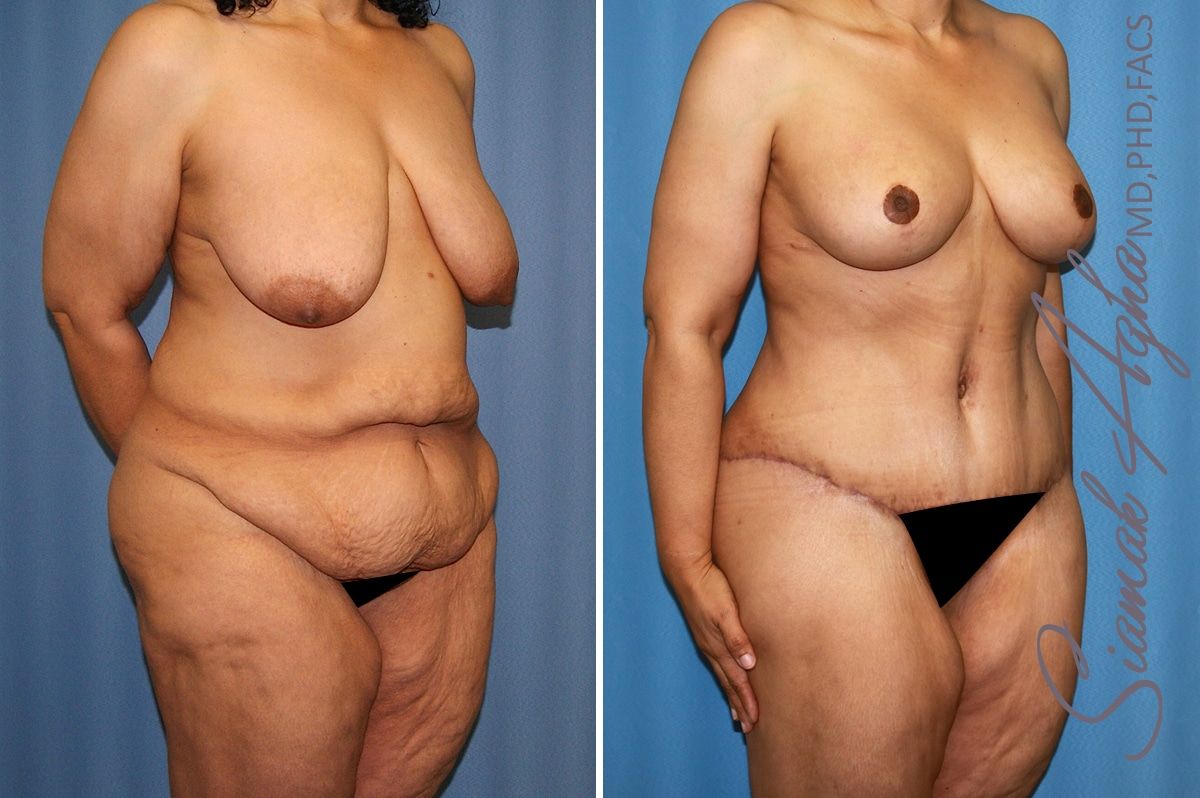 Total Body Lift Before & After