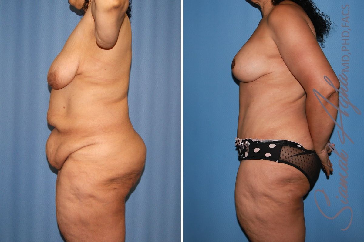 Total Body Lift Before & After