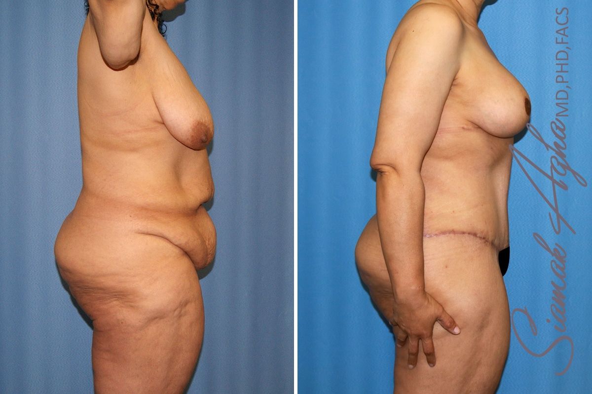 Total Body Lift Before & After