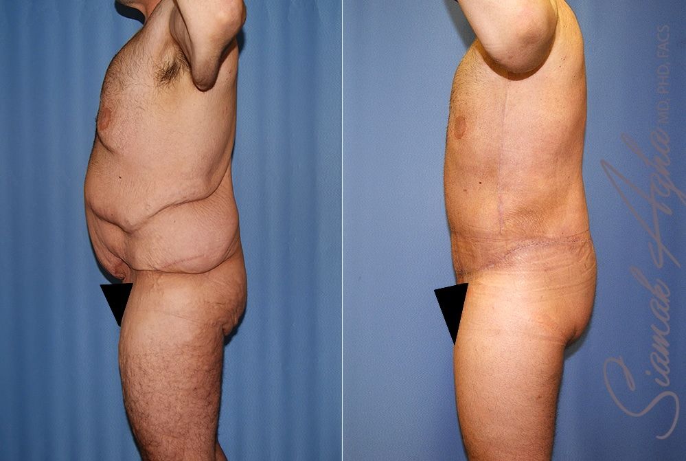 Total Body Lift Before & After