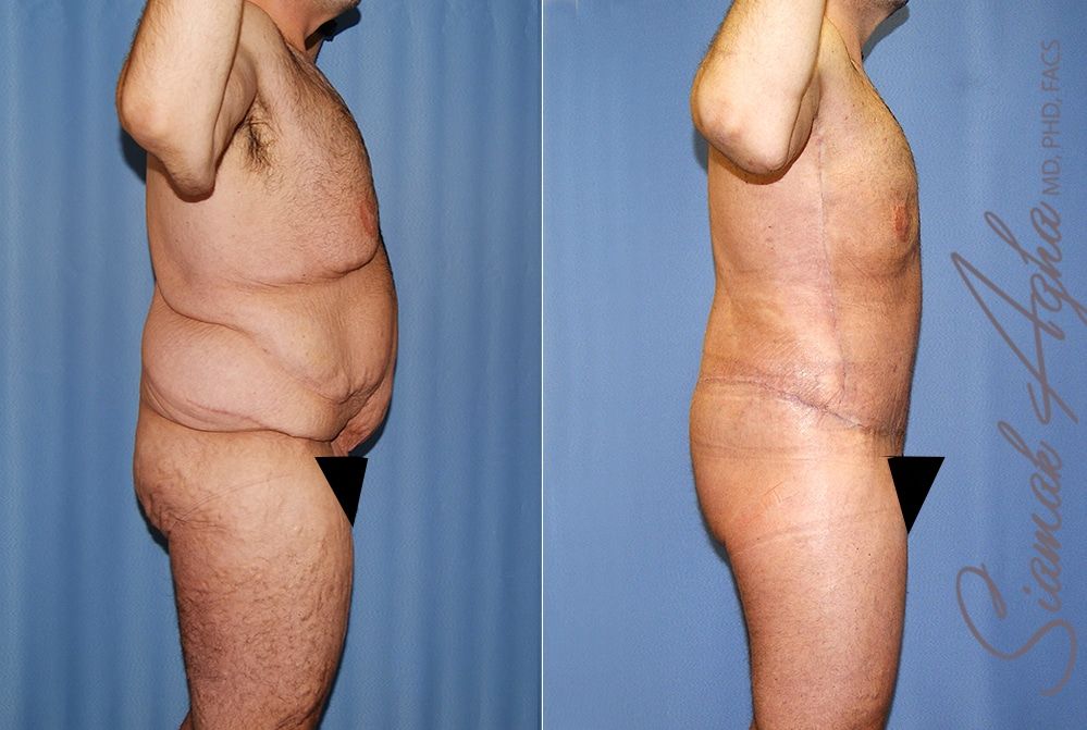 Total Body Lift Before & After