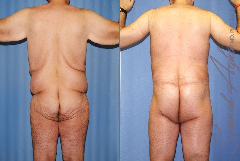 Total Body Lift Before & After