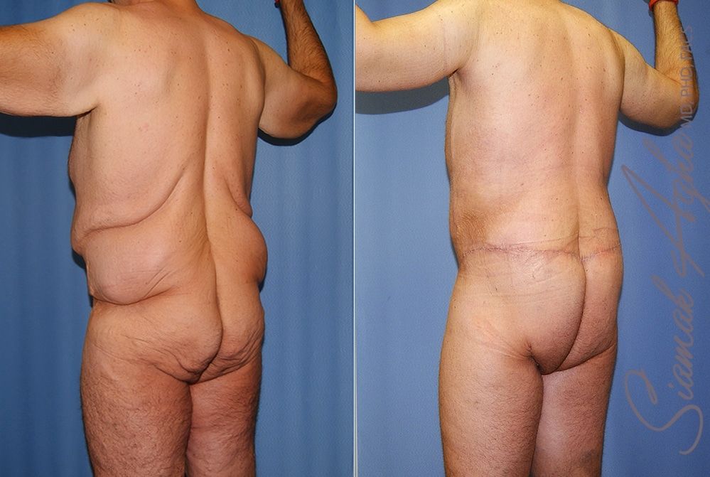 Total Body Lift Before & After