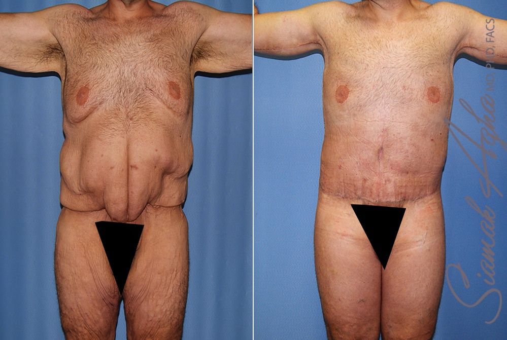 Total Body Lift Before & After