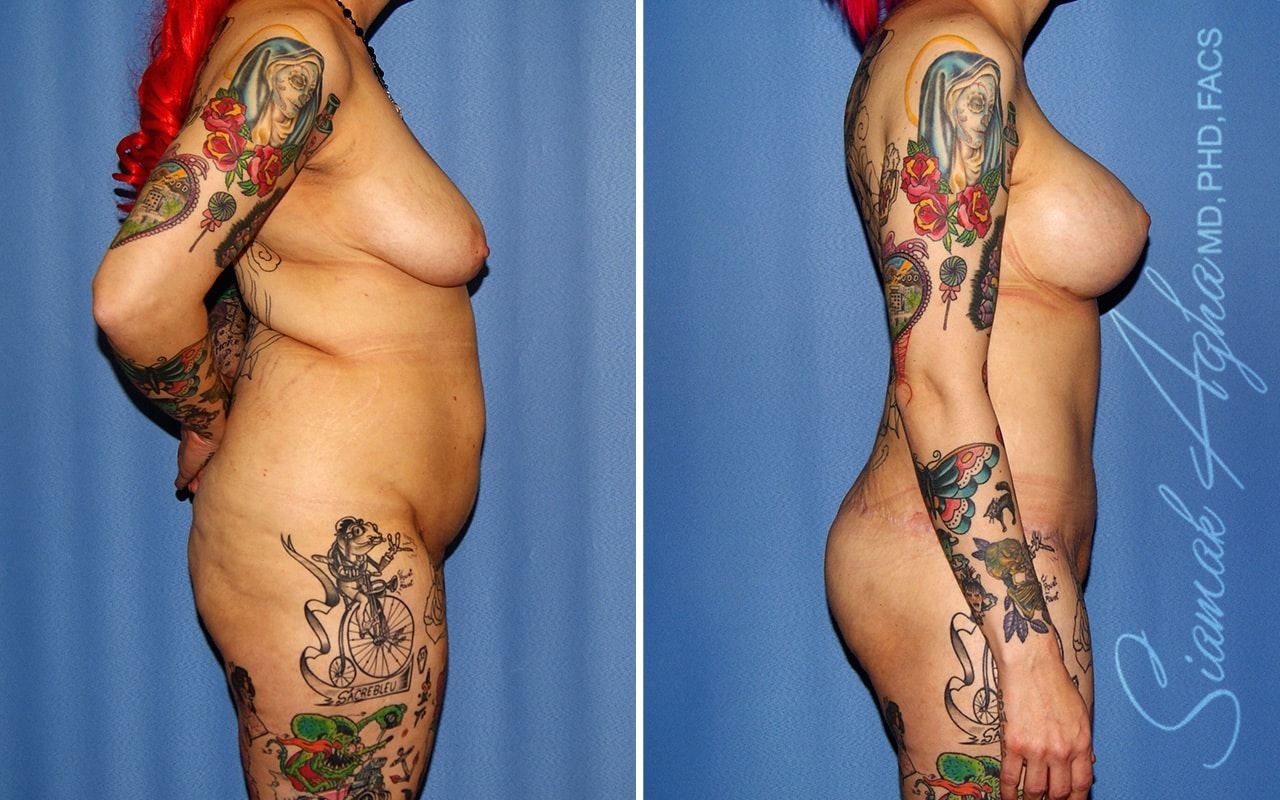 Total Body Lift Before & After