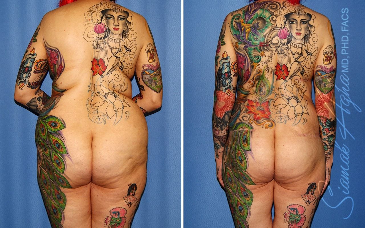 Total Body Lift Before & After