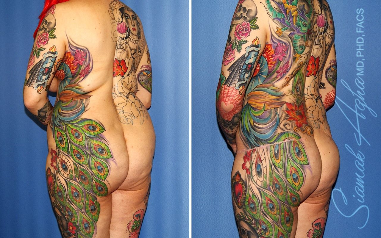 Total Body Lift Before & After