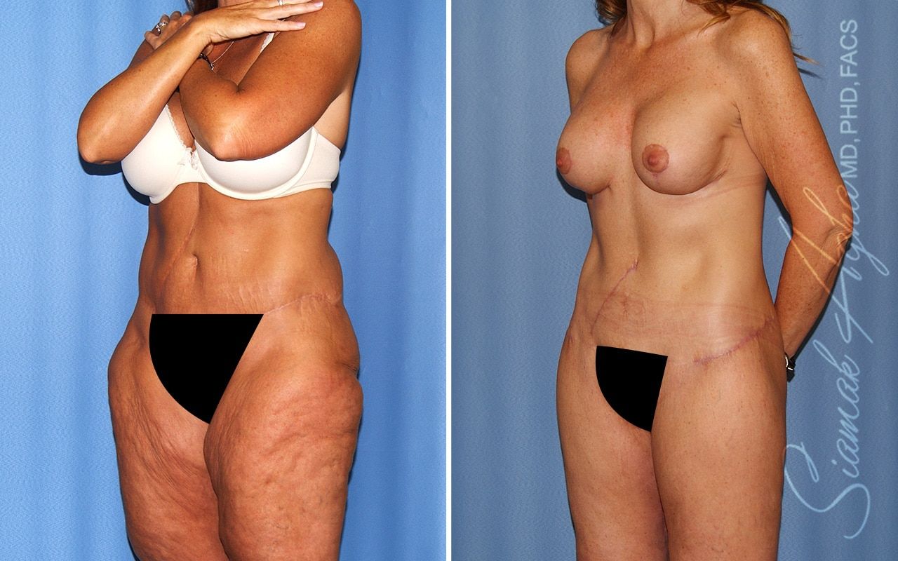 Total Body Lift Before & After