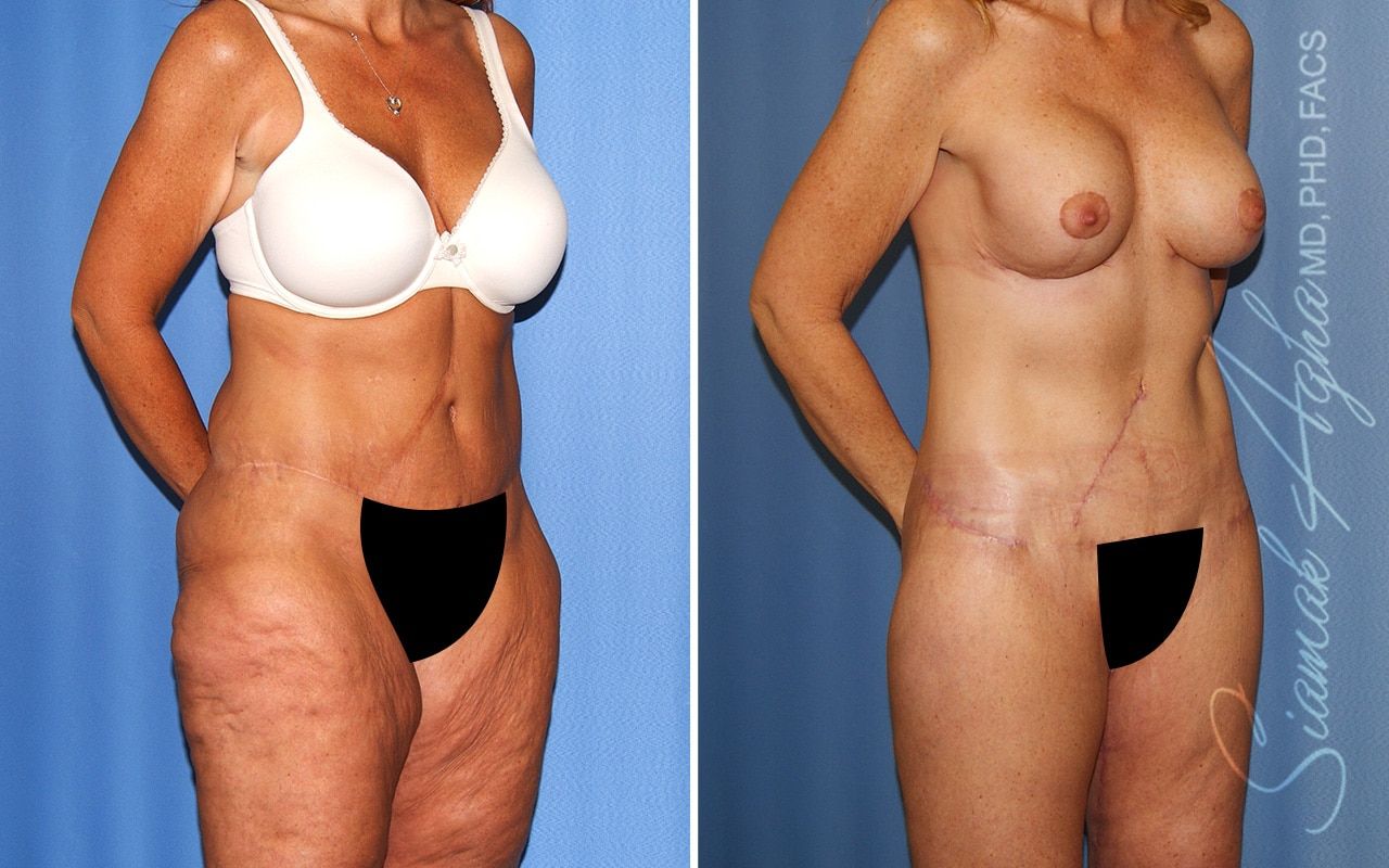 Total Body Lift Before & After