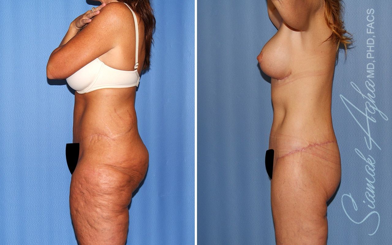 Total Body Lift Before & After