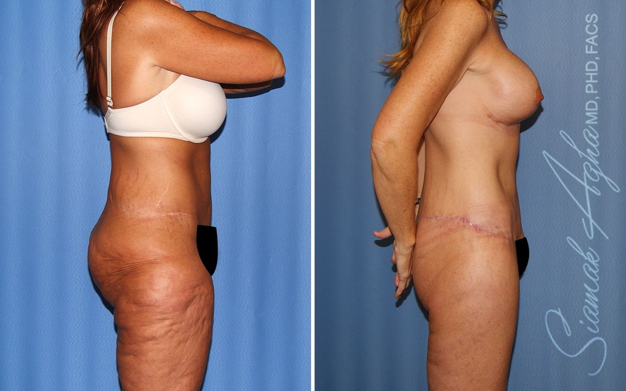 Total Body Lift Before & After