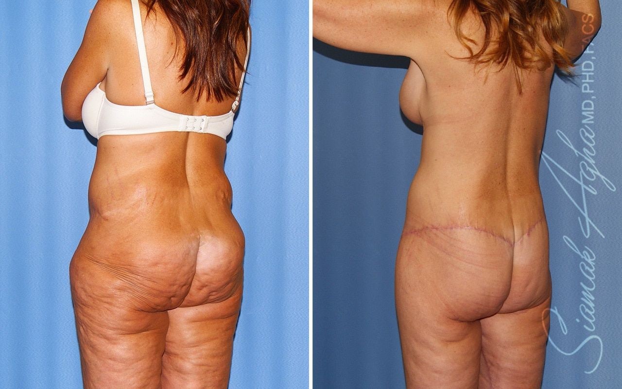 Total Body Lift Before & After