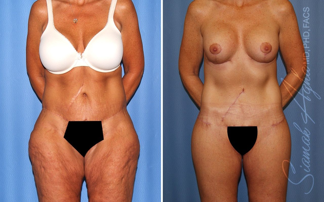 Total Body Lift Before & After