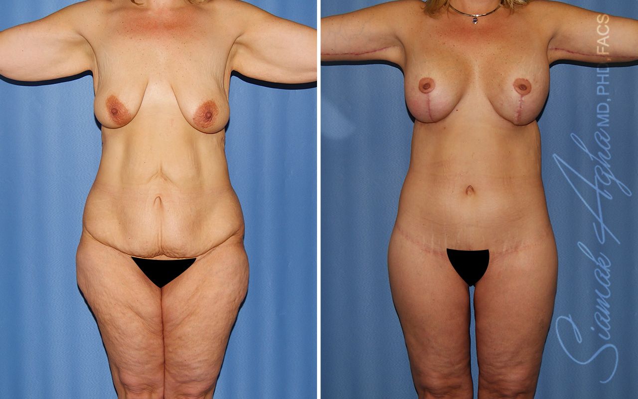 Total Body Lift Before & After